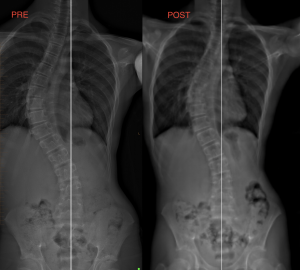 Scoliosis Therapy