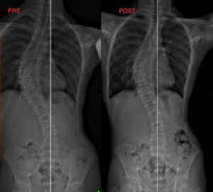 scoliosis therapy