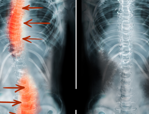 Neuromuscular Re-Education: A Promising Treatment For Scoliosis